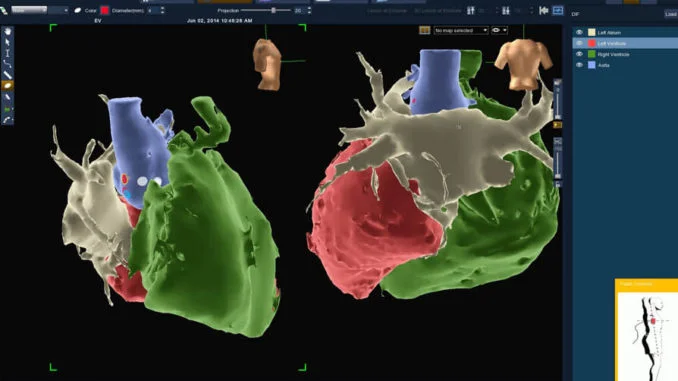 Mappaggio cardiaco con sistema Ensite Precision