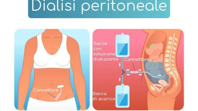 dialisi-peritoneale