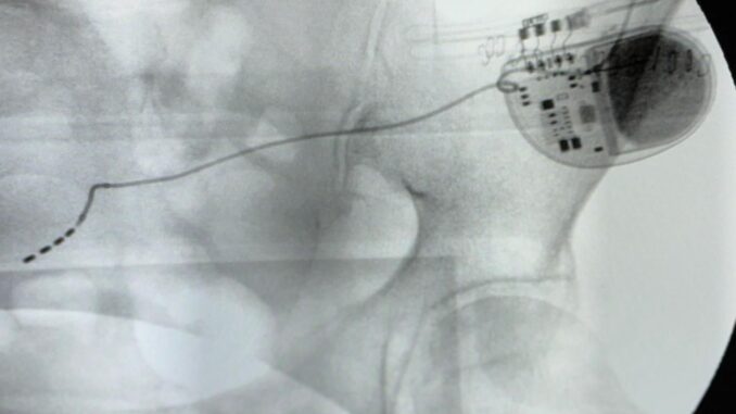 AOR-SanCarlo_stimolazione_sacrale_1