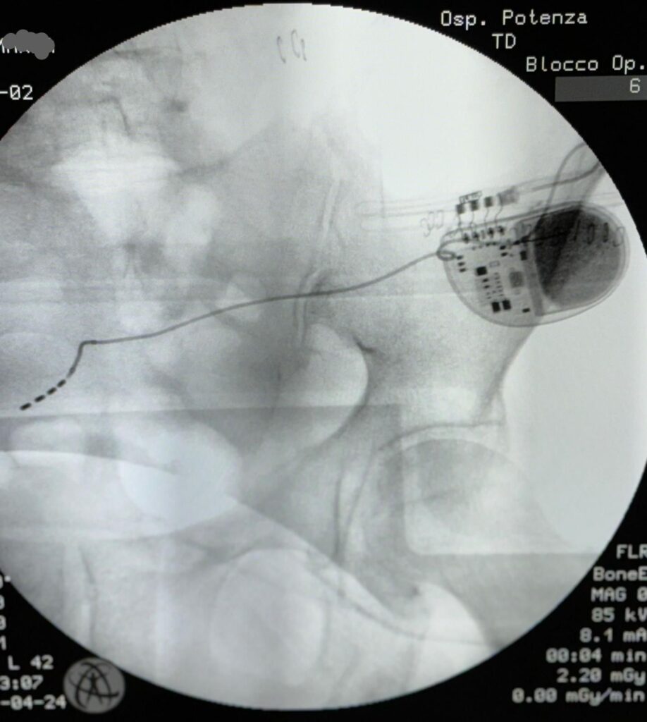 Aor-del_8-5-2024_su_Terapia_del_Dolore_stimolazione-sacrale terapia