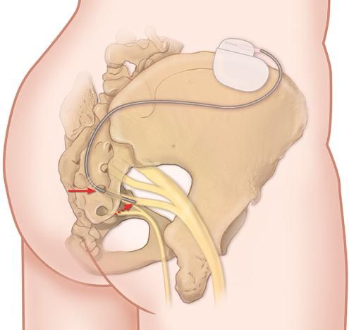 terapia